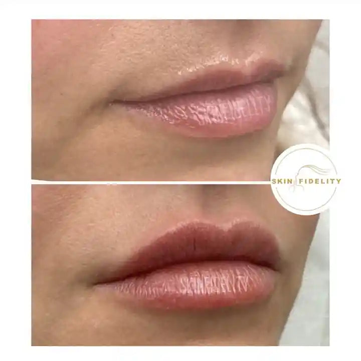 Before and after lip filler with a defined lip border at SKINFIDELITY in Kleinburg
