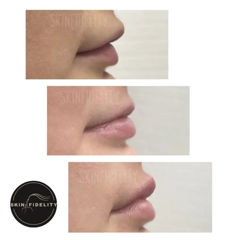 Lip filler before, after dissolving and after a natural redo at SKINFIDELITY
