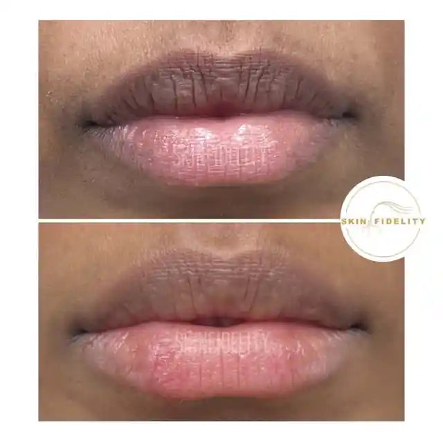 Before and after natural lip filler, front view, at SKINFIDELITY in Mississauga