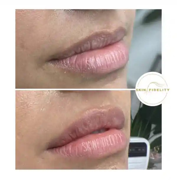 Side view before and after subtle lip filler at SKINFIDELITY