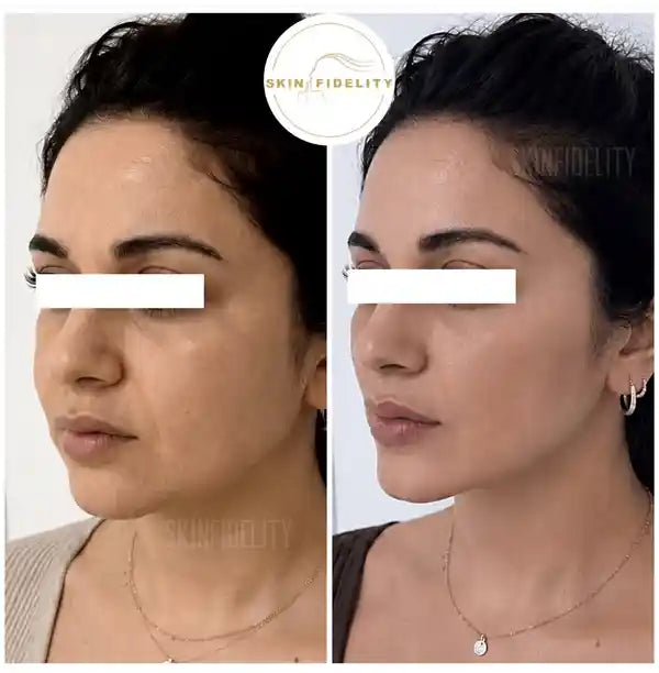 Before and after thread lift with a defined jawline contour at SKINFIDELITY in Kleinburg