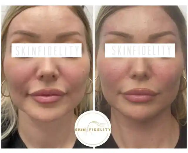 Before and after dissolving overfilled facial filler at SKINFIDELITY