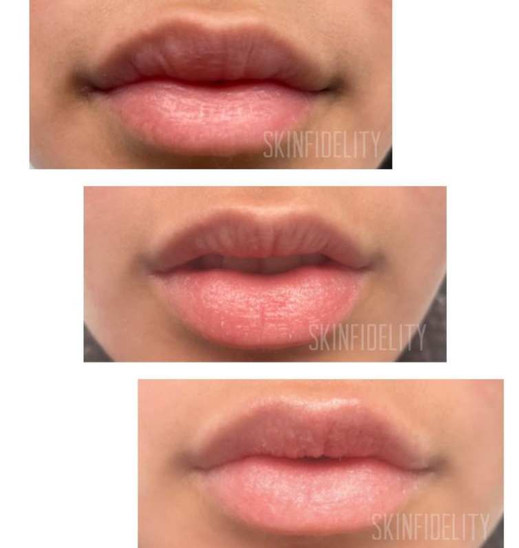 Botched Lip Filler Correction – SKINFIDELITY