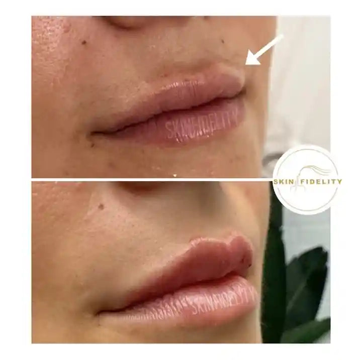 Before and after migrated lip filler correction at SKINFIDELITY in Mississauga