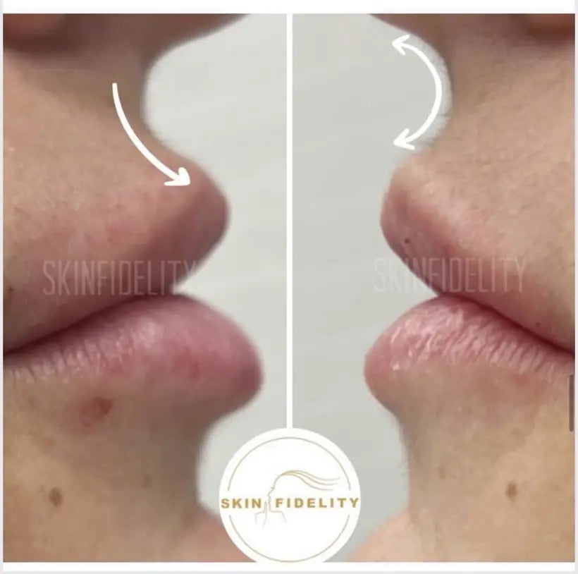 Side profile before and after correcting a lip filler shelf at SKINFIDELITY