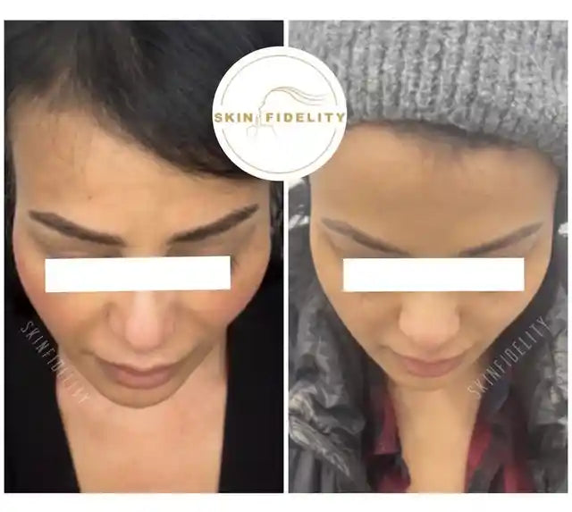 Before and after overfilled cheek filler correction at SKINFIDELITY in Kleinburg