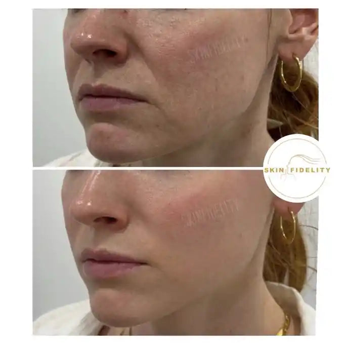 Before and after thread lift for jowls and the lower face at SKINFIDELITY