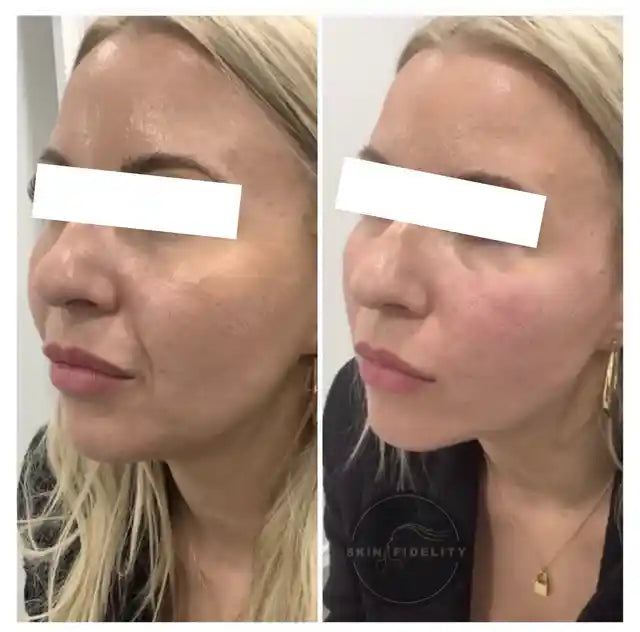 Before and after thread lift for the cheeks and jawline at SKINFIDELITY in Mississauga